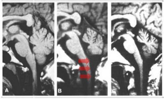 Imagem 6: doença de Machado-Joseph: estudos de imagem cerebral geralmente revelam atrofia pontocerebelar e alargamento do quarto ventrículo (setas).
