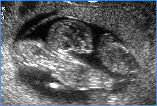 Revisão de Literatura 13 Figura 1 - Imagem de exame ultrassonográfico de primeiro trimestre demonstrando gestação gemelar monocoriônica monoamniótica O diagnóstico precoce assim como a vigilância