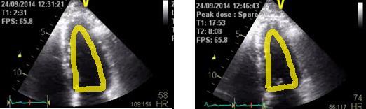 Ecocardiograma de estresse, corte apical quatro câmaras, imagens em repouso e pico, com resposta normal (Dobutamina).
