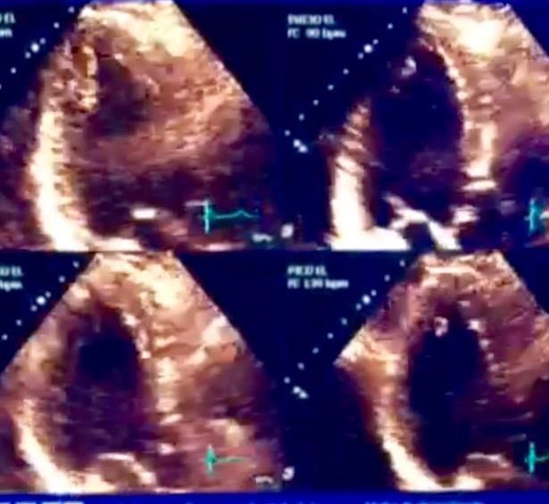 Figura 22. Ecocardiogroma de estresse físico em bicicleta horizontal em paciente com história de IAM e angioplastia primária com implante de stent em ACx.