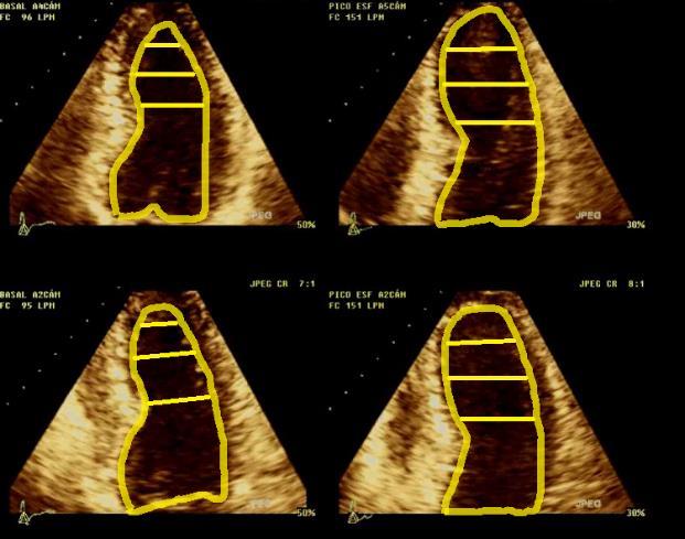 Ecocardiograma com estresse físico (esteira), cortes apical