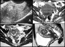 Fig. 1 Leiomioma uterino submucoso em mulher com menometrorragias.