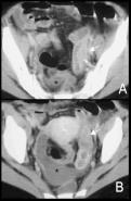 Fig. 5 Salpingite subguda em mulher com dispositivo intra-uterino, referindo dor pélvica aguda e febre.