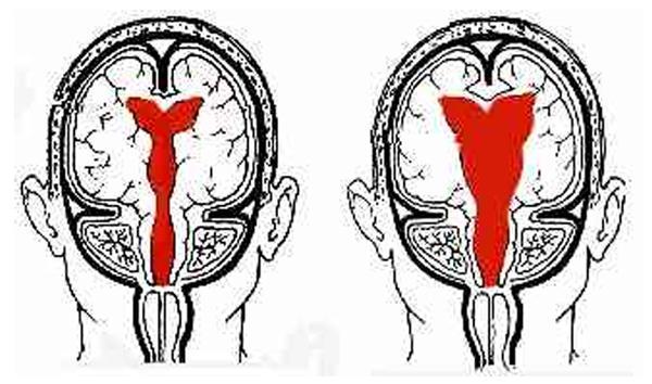 31 Existe considerável evidência de que o ventrículo tem três fases distintas de compressividade, conforme indicado abaixo: 1ª Fase o ventrículo é muito incompressível ou inelástico; neste caso, a