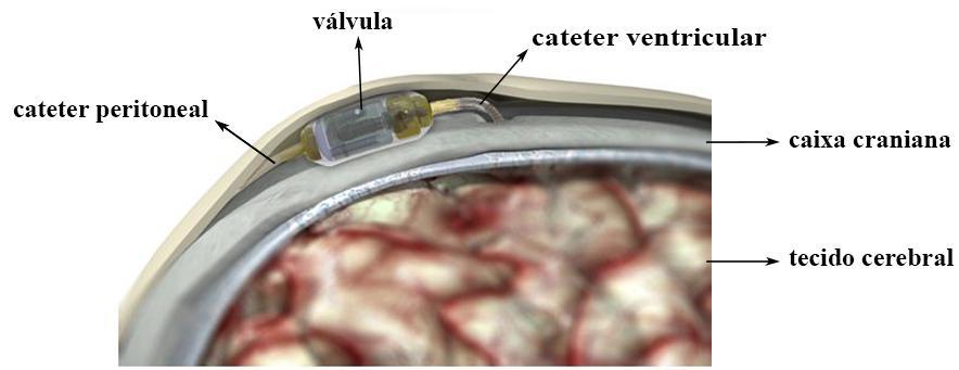 a conexão do cateter peritoneal, o dispositivo para o controle da vazão do líquor e o revestimento que envolve os componentes internos da válvula neurológica (Figura 4.1).