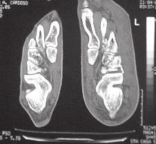 2a Radiografia oblíqua do pé mostrando fratura da base do segundo osso metatarsal (seta) e esmagamento com encurtamento do osso cubóide (círculo pontilhado), sugerindo trauma em abdução do pé Fig.