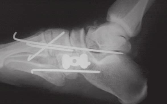 2b Corte axial de tomografia computadorizada dos pés, mostrando fratura cominutiva do osso cubóide com desvio articular significativo da articulação calcâneo-cubóide (círculo pontilhado) Fig.