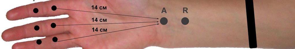 A diferença das latências pelo pico na distância de 14cm não deve passar de 0,5cm de acordo com a padronização