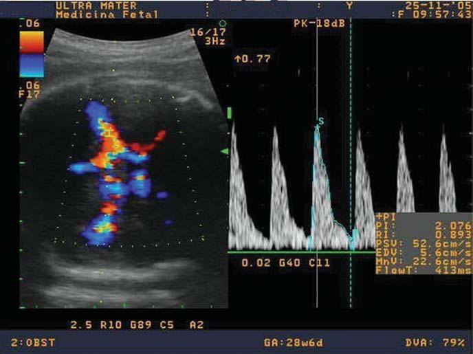Dopplervelocimetria fetoplacentária em gestantes hipertensas de morte fetal e 6,5% de mortes neonatais (Tabela 2). Figura 2.