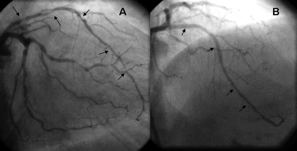 No painel A, observamos presença de múltiplas lesões obstrutivas acometendo 1/3 proximal, médio e distal da artéria DA.