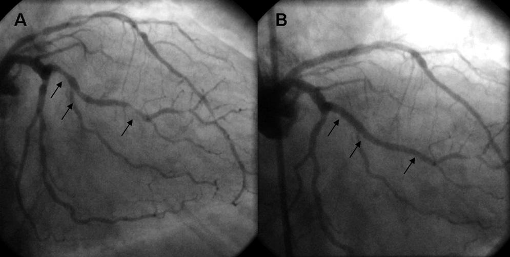 Figura 3 - Ramo marginal da artéria circunflexa pré e pós-angioplastia. Observa-se acometimento do 1/3 proximal e médio do grande ramo marginal da artéria CX (setas, painel A).
