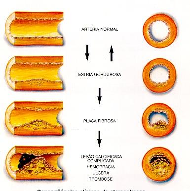 A T H E R O S C L E R O S I S P R O G R E S S I O N Normal Artery Fatty Streak