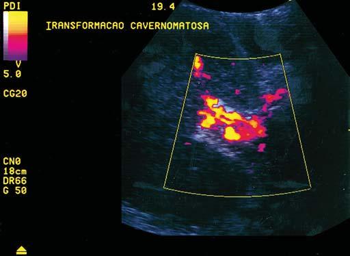 A: Imagem em modo B demonstrando colaterais serpiginosas no hilo hepático. B: Doppler colorido demonstrando as colaterais.