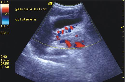 trombos. Em alguns desses casos, o Doppler pulsado pode revelar a presença de algum fluxo residual, mesmo na ausência de lúmen vascular identificável (3).