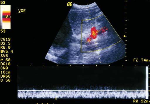 Estudo Doppler na hipertensão portal As colaterais envolvendo o território da veia gástrica esquerda podem ter sua avaliação prejudicada pela obesidade e em pacientes em que o lobo esquerdo do fígado