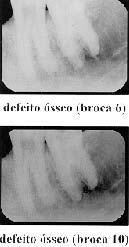 Figura 7 - Imagens tomográficas digitalizadas de controle (sem defeito ósseo) e dos defeitos ósseos realizados com as brocas, 6 e 1.
