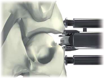 9 opção 1 Inserção do implante Opção do Introdutor deslizante O Introdutor do implante é posicionado em relação à porção anterior da vértebra.