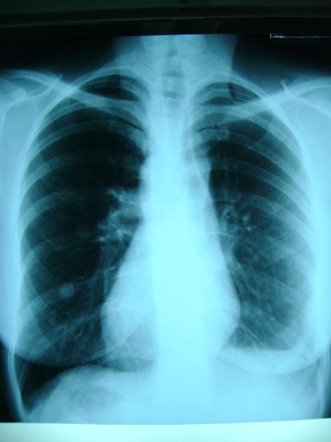 Radiografia 3: paciente em momento pós-cirúrgico de excisão de nódulos. Fonte: Os autores (1997).