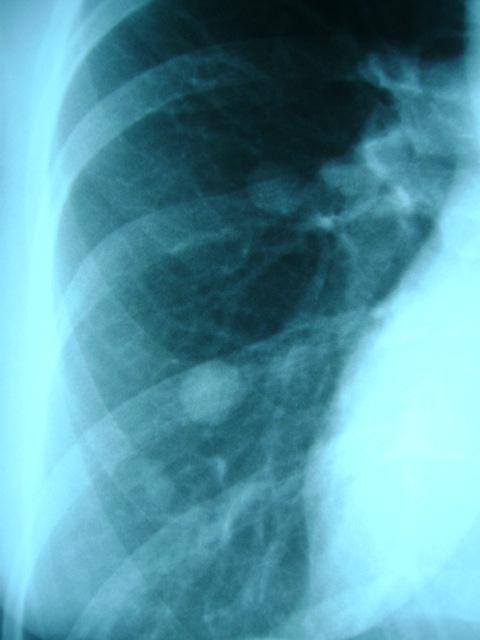 Radiografia 4: paciente em momento pós-cirúrgico (detalhe HTD). Fonte: Os autores (1997).