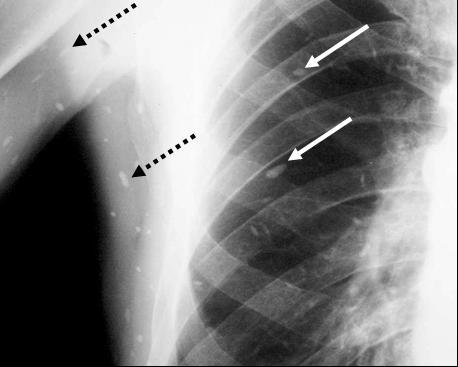 Figura 1. Nódulos pulmonares múltiplos (setas brancas).
