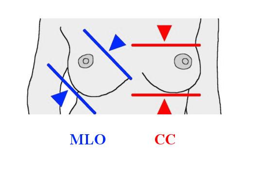 Capítulo 3. Imagiologia do Cancro da Mama 19 Figura 3.2: Representação esquemática das projecções cranio-caudal (CC) e médiolateral oblíqua (MLO).