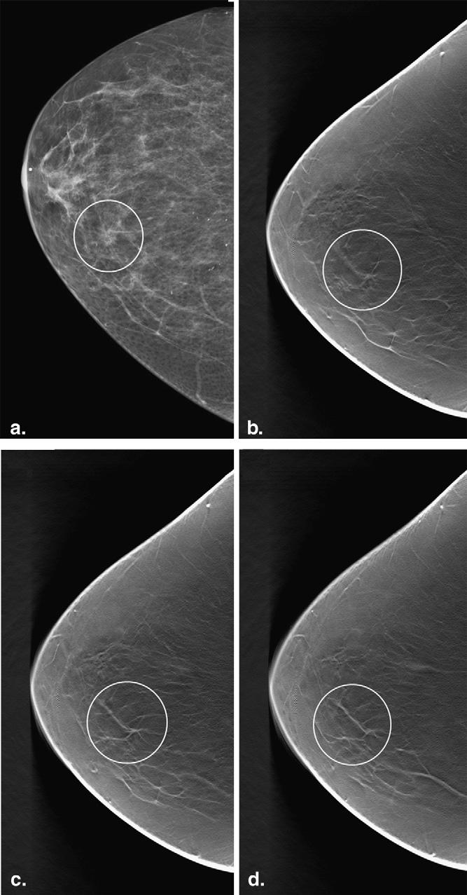 22 Capítulo 3. Imagiologia do Cancro da Mama Figura 3.3: Comparação de imagem de mamografia, contendo um falso-positivo, com as imagens de tomossíntese correspondentes.