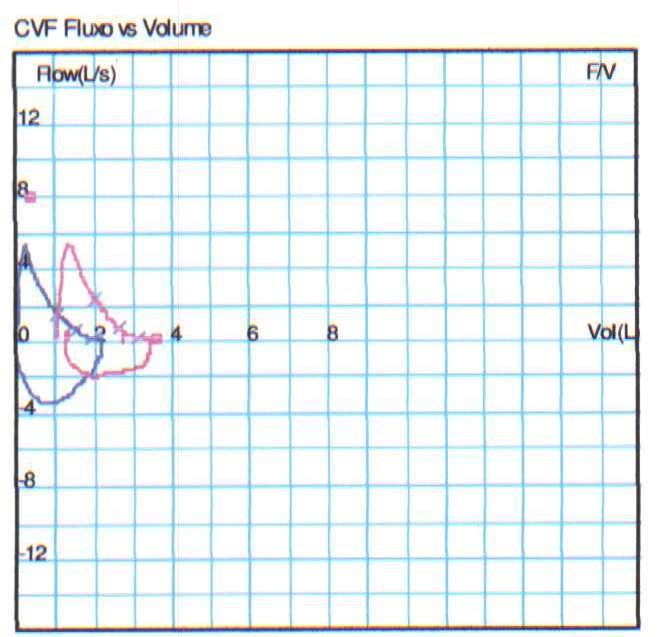 Descreva os principais achados da Curva fluxo volume abaixo.