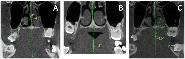 64 Figura 1. Terceiros molares superiores classificados de acordo com a inclinação vestibulo-palatal em (A) vestibular, (B) central e (C) palatal.