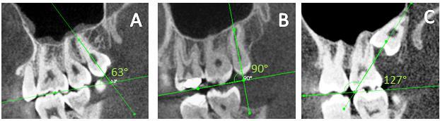 superior e outra linha passando pelo plano oclusal do primeiro molar superior do mesmo lado.