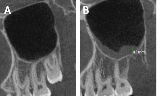 66 Figura 4. Avaliação da mucosa sinusal na região do terceiro molar no exame pré-operatório (A) e no pós-operatório (B).