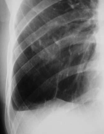 2.5 Decúbito lateral com raios horizontais Esta incidência se presta basicamente para diferenciação entre derrame e espessamento pleural.