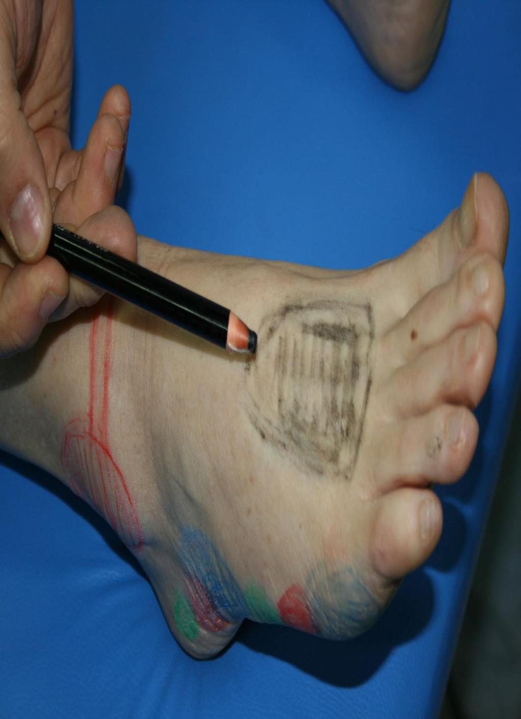 Reflexologia dos pés e seu uso na APS