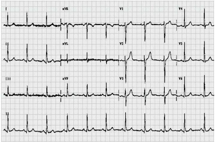 Monitoramento de Arritmia Eletrocardiograma