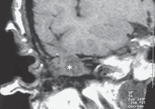 é o segmento mais comumente acometido da cadeia ossicular (87% dos casos).