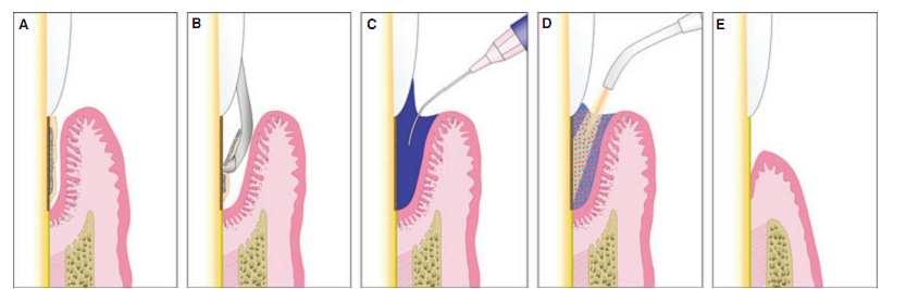 2.3 Terapia Fotodinâmica em Periodontia 2.3.1 Técnica de Aplicação (figura 2) Após realização do debridamento mecânico com curetas manuais dos sítios periodontalmente doentes (A, B), o