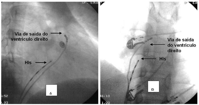 A estimulação ventricular programada era repetida após uma infusão adicional de 1 a 5 g/min de isoproterenol, no intuito de documentar as EVSVD antes e após a ablação e afastar a possibilidade de