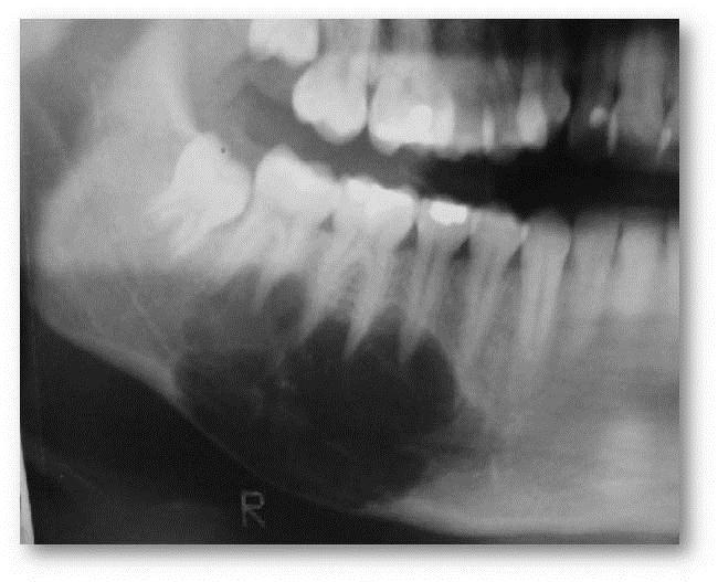 direito, em contato com as raízes dos dentes 45,46 e 47, sem causar reabsorção (Figura 1). Estes dentes apresentavam vitalidade pulpar ao teste térmico.