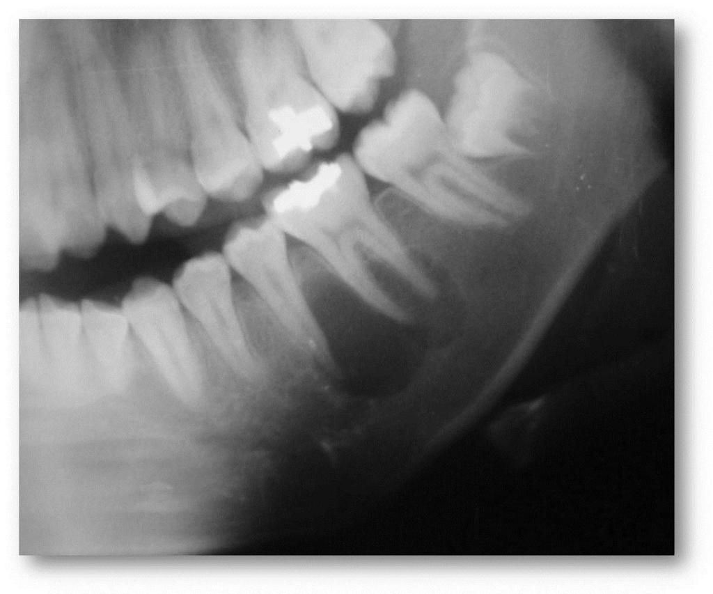 Figura 4 - Radiografia oclusal exibindo imagem radiolúcida Figura 5 - Controle radiográfico sete meses Figura 6 - Controle radiográfico sete meses DISCUSSÃO O Cisto Ósseo Simples é uma lesão incomum