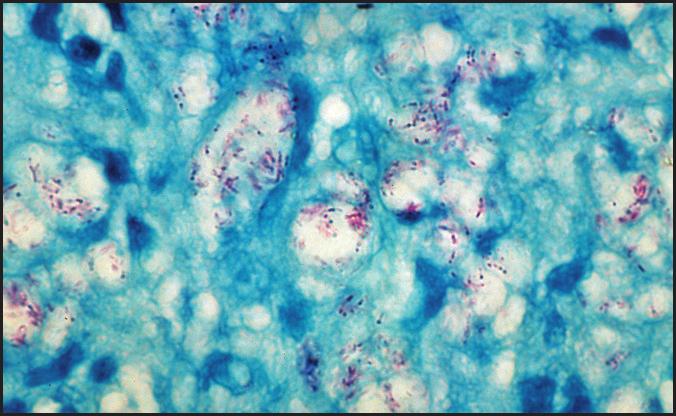 protegendo-se da destruição. Nos macrófagos em repouso, as micobactérias persistem e replicam-se nessas vesículas.