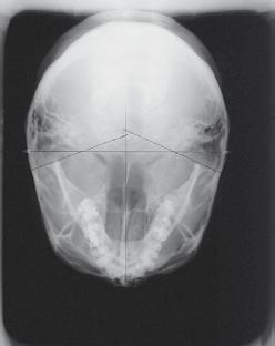 ATM P6 Articulação têmporo-mandibular