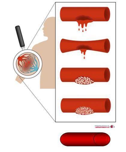 Mecanismos de hemostase 1. Parede vascular rompida 2. Vasoconstrição (induzida pela 5-HT e TXA2 libertados pelas plaquetas) 3.