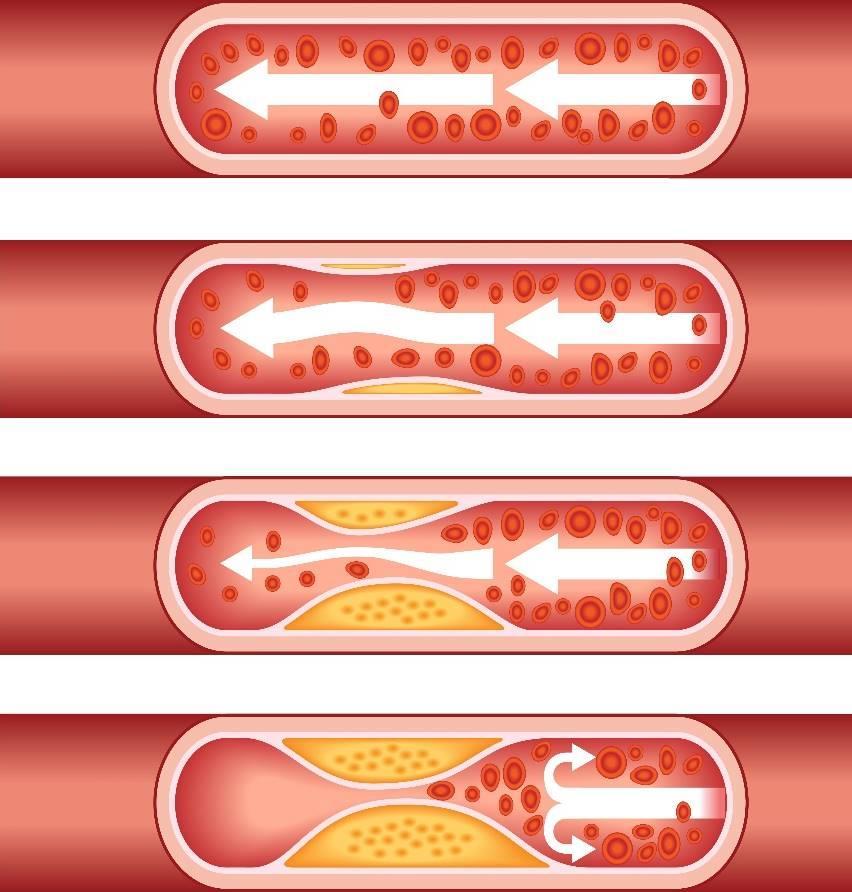 Aterosclerose Doença inflamatória crónica da parede das artérias 1. Excesso de colesterol LDL em circulação 2. Lesões no endotélio com apósitos de LDL 3.