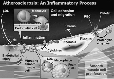 Aterosclerose Acumulação subendotelial de macrófagos enriquecidos em colesterol (células esponjosas lesões precoces da aterosclerose = estrias gordas Proliferação de células musculares