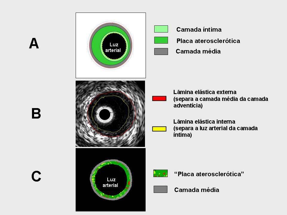 Métodos 25 Existem diferenças no que concerne ao delineamento da placa aterosclerótico na ultrassom em escala de cinza e na histologia virtual.