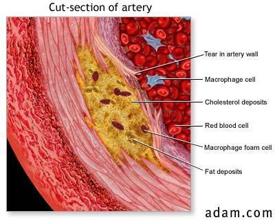 Definição Afecção de artérias de grande e médio calibre, caracterizada por acúmulo