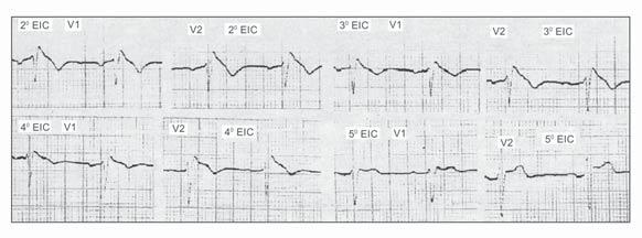 São alterações na despolarização e na repolarização ventricular, na ausência de alterações estruturais cardíacas ou outra condição que conhecidamente possa supradesnivelar o segmento ST em