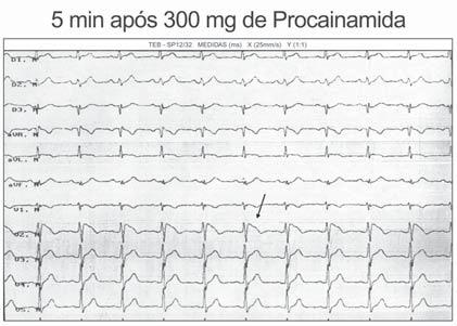expressam a condução intramiocárdica lenta, com inscrição além do final da despolarização ventricular
