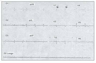 Revista da SOCERJ - Jul/Ago/Set 2004 175 11 10 12 No tromboembolismo pulmonar, pode-se observar, em precordiais direitas (Figura 12) e derivações inferiores, uma elevação do segmento ST com inversão