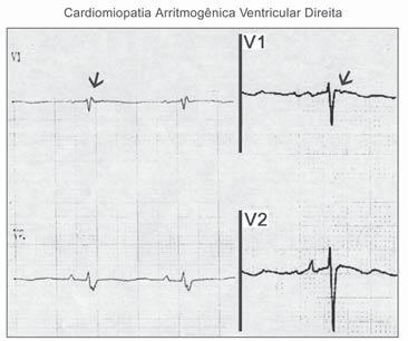 Nem sempre é fácil o diagnóstico diferencial desta condição com infarto agudo do miocárdio ântero-septal.