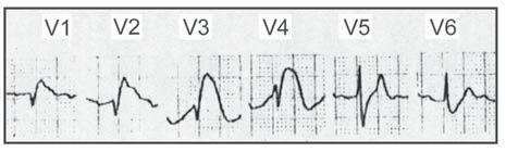 Mas, neste caso, a morfologia de V3 com ondas T altas e apiculadas e a de D2 com ondas S espessadas e ondas T também apiculadas, indicam o diagnóstico do distúrbio eletrolítico 12.